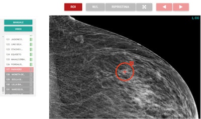 Region-of-interest delineation in a magnified craniocaudal projection. No more than one region of interest can be placed on each projection. If a case is left with a region of interest placed on a mammographic projection, it will be classified as true positive if the region of interest matches the one previously delineated during dataset building for the actual presence of carcinoma; otherwise, the case will be classified as a false positive. To store the case as a negative one and move on to the next one, the reader can click on the button with white arrowheads on green background (shown at the right end in top figure [Example of mediolateral oblique projection magnification]). The case will be classified as true negative if carcinoma is not actually present, otherwise as a false negative.