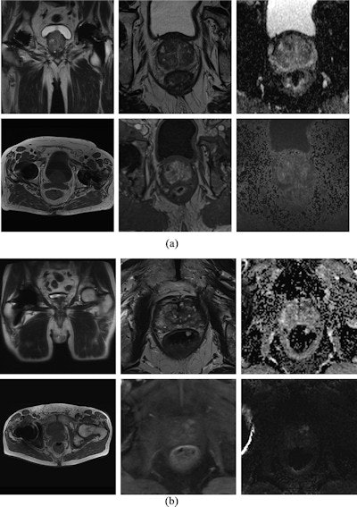 Diagnostic MRI at 1.5 tesla and 3 tesla. MpMRI without impairment of diagnostic value at 1.5 tesla (a) and 3 tesla (b). Top left shows localizer with little susceptibility artifacts caused by the total hip replacement. Top center: T2-weighted images. Top right: Apparent diffusion coefficient maps. Bottom left: T1-weighted images. Bottom center: T1 volumetric interpolated breath-hold examination (VIBE) for dynamic contrast-enhanced images. Bottom right: Diffusion-weighted imaging high b-values (b1800). Image courtesy of the European Journal of Radiology.