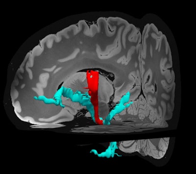 Rendered with Freesurfer -- Template: Edlow 7-tesla MRI of the ex vivo human brain at 100 micron resolution. Images courtesy of Dr. Quirin Strotzer.