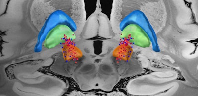 Rendered with LEAD-DBS -- Template: Edlow 7-tesla MRI of the ex vivo human brain at 100 micron resolution.