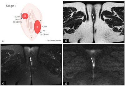 (a) Schematic illustration of International Federation of Gynaecology and Obstetrics (FIGO) stage I. Axial T2-weighted image (b), axial fat saturation T2-weighted image (c) and diffusion-weighted imaging with b-value = 800 s/mm2. (d) shows a vulvar tumor measuring < 2 cm, with pathologic proven stromal invasion of 4 mm, corresponding to FIGO stage IB. All images courtesy of Dr. Olivera Nikolić and Insights into Imaging.