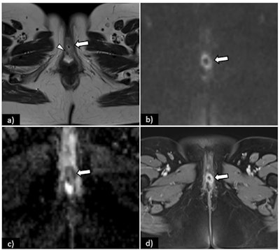 Axial T2-weighted image (a) shows an intermediate signal intensity tumor (arrow), measuring 3 cm, with central necrosis and invasion of the external urethral meatus (arrowhead) -- FIGO II. On diffusion-weighted imaging, the tumor is depicted by a high signal intensity lesion (b-value = 1000 s/mm2) (arrow), and low signal intensity on the corresponding ADC map (arrow). On T1WI fat saturation contrast-enhanced sequence (D), the tumor shows early arterial enhancement of its solid component (arrow), with no enhancement of the central necrotic portion. Note the increased conspicuity of the lesion in diffusion-weighted MRI (b) and (c) and in DCE-MRI (d).