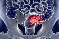 2021 10 04 18 47 3377 Colorectal Cancer 400