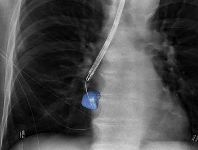 3D image guidance provided via conebeam CT and 'augmented' fluoroscopy can improve accuracy in biopsies of peripheral lung lesions. CBCT Image courtesy of Philips Healthcare.
