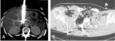 Two cases that underline the importance of CT examinations in ballistic assessment of trauma. A: Stab trauma coming in close contact with the inferior vena cava. multiple gunshot trauma (B). All images courtesy of the Drs. Mathieu Di Bisceglie, Kathia Chaumoître, and JFR e-Quotidien.