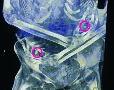 Dental condition and various skeletal characteristics were used to determine the age of this woman, with artificial cranial deformity, at between 20 and 40 years of age