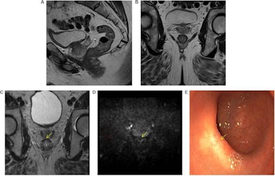 High accuracy identifying complete responders after chemoradiotherapy has been reached with the use of a three-modality approach, including digital rectal exam with endoscopy, T2-weighted MRI, and diffusion-weighted imaging. A low rectal tumor is seen on MRI (A, B). On restaging MRI eight weeks after completion of chemoradiotherapy (C), only minimal fibrosis (yellow arrow) is seen anteriorly in the rectal wall. On restaging diffusion-weighted imaging (D), there is absence of high diffusion signal (yellow arrow). Clinical assessment by endoscopy (E) reveals a white scar with telangiectasia (yellow arrow). Figure courtesy of Drs. Hester E. Haak, Monique Maas, Stefano Trebeschi, and Regina G.H. Beets-Tan and Frontiers in Oncology.