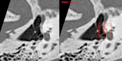 45-year-old woman with predominantly right-sided unilateral conductive hearing loss. Double oblique view of the stirrup. Stapedial otosclerosis with isolated isodense filling of the fissula ante fenestram detected by the Oto-Med recognition tool. Courtesy of e-Quotidien, daily newspaper of Journées Francophones de Radiologie (JFR).