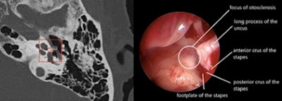 Oto-Med / Surgery agreement in a patient operated on for left stapedial otosclerosis. Figure courtesy of Dr. Arnaud Attyé, Grenoble University Hospital Center, France.