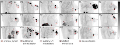 Fibroblast-activation protein inhibitor breast PET/MRI scans. Oblique coronal projections of prone breast PET/MRI maximum intensity projection images in all 18 patients who underwent breast PET/MRI. Image intensities are adjusted to standardized uptake value on a scale of 0-10. Image courtesy of Radiology.
