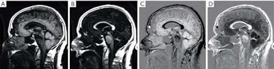 Sagittal images of a normal brain. mTIs nulling white matter (A), mTIi nulling gray matter (B), SIR (mTIs -- mTIi) in (C) and rSIR (mTIi -- mTIs) in (D). There is high gray white matter contrast with gray matter high signal and white matter low signal in (C). In (D) the gray white matter contrast is reversed with white matter white, and gray matter black. Cerebral spinal fluid is of intermediate signal near the noise level in both (C) and (D). SIR, subtracted inversion recovery; TI, inversion time; rSIR, reversed subtraction inversion recovery. Image courtesy of Drs. Ya-Jun Ma, Hongda Shao, Shujuan Fan, Xing Lu, Jiang Du, Ian R. Young, and Graeme M. Bydder and Quantitative Imaging in Medicine and Surgery, October 2020.