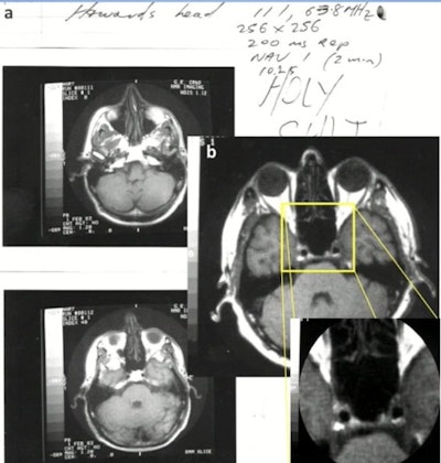 1.5T: General Electric normal subject T1-wSE. Paul Bottomley's lab notebook and images (February 1983). The high-field (1.5-tesla) results were 'totally unexpected,' Bydder said. Image courtesy of MRIS History UK.