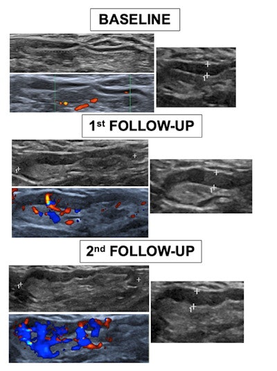 Comparative ultrasound images from one volunteer between baseline and the first and second follow-ups shows a significant gradual increment of maximum diameter, cortex, Bedi’s classification, and Doppler scale degree. Image courtesy of Dr. Alba Cristina Igual‐Rouilleault and European Radiology.