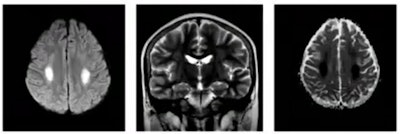 Pathologies induced by taking toxic substances, such as methotrexate toxicity. Neurotoxicity related to methotrexate can result in a range of acute and chronic leukoencephalopathies, and permanent neurological deficits may be unilateral or bilateral. Courtesy of Dr. Riyad Hanafi, CHU de Lille, and JFR 2021.