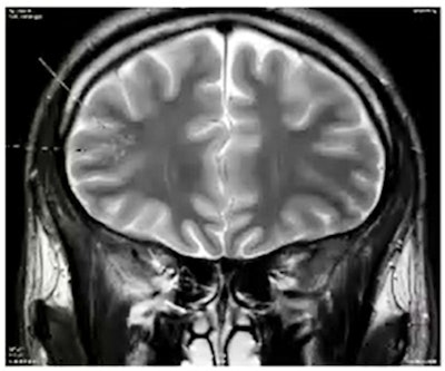 19-year-old patient with multinodular and vacuolated neuronal tumor (MVNT). These benign neuronal lesions have a distinct cytoarchitectural pattern that may be related to ganglion cell tumors. Courtesy of Dr. Ali Amad, CHU de Lille, and JFR 2021.