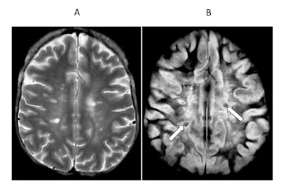 Transverse image of the brain in a case of multiple sclerosis T2 spin-echo (SE) (A) and subtracted inversion recovery (SIR) (B) images. Very long T1 high signal lesions are seen in (A) and show intermediate signal in (B) (arrows). Other lesions appear much more extensive in (B) where abnormalities extend towards the peripheral U fibers in most of the white matter. Image courtesy of Ya-Jun Ma, Hongda Shao, et al and Quantitative Imaging in Medicine and Surgery.