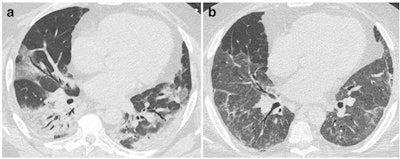 CT features at baseline and at discharge in a 52-year-old man who developed severe COVID-19 pneumonia (intubation, extracorporeal membrane oxygenation, 45 days in intensive care unit). a: Baseline CT shows bilateral consolidation and ground glass opacities (GGOs) with peripheral and peribronchovascular distribution. b: 2-month CT follow-up demonstrates the complete resolution of consolidation, with residual parenchymal bands bilaterally, while GGOs appear more extensive ('tinted sign') in the lower lobes, lingula, and right middle lobe. Note the improved expansion of the left lung in b. Figures courtesy of Dr. Katharina Martini et al. and European Radiology.
