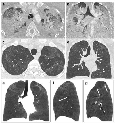 CT features at baseline, and one-year follow-up, in a 30-year-old woman who developed severe COVID-19 pneumonia (intubation, 40 days in intensive care unit). a,b: Baseline CT showing extensive ground glass opacities (GGOs) and consolidation. c–g: 1-year CT follow-up. Residual GGO, with a linear shape, is mainly seen in the upper lung, suggestive of organizing pneumonia at a late phase. There is no bronchial dilatation, signs of architectural distortion, or honeycombing, as confirmed by minimum intensity projections (minIP) (e, f, g). The sagittal minIP reformations (f, g) demonstrate plurilobular areas of decreased attenuation (arrows). This mosaic attenuation pattern might be due to either residual small airway disease or peripheral vascular obstruction. Decreased diffusing capacity (DLCO) at one year was 64%.