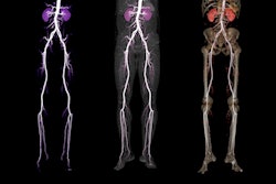 2021 11 03 17 13 4861 Cta Femoral Artery Run Off 3 D 400