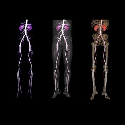 2021 11 03 17 13 4861 Cta Femoral Artery Run Off 3 D 400