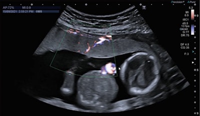 Ultrasound image of shared placenta with a blood vessel linking the two circulations shown in color using low-flow Doppler. Image courtesy of Imperial College Healthcare NHS Trust.