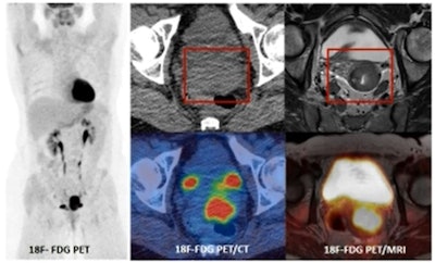 PET/MRI provides a one stop examination for staging cervical cancer due to the superior contrast resolution of MRI compared to CT. All images courtesy of Prof. Vicky Goh, presented at the BIR Annual Congress.