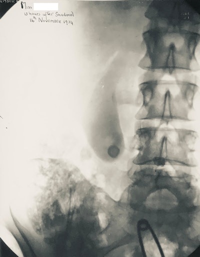 Oral cholecystogram from 1934 showing opacified gallbladder. The technique has now been replaced by ultrasound.