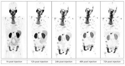 PET scans in a patient with metastatic castration-resistant prostate cancer imaged over multiple time points between one and 72 hours after administration of Cu-64 SAR-bisPSMA. Image courtesy of Clarity Pharmaceuticals.