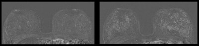 Breast MRI of a 41-year-old patient. The left image is without an IUD in place, while the right image shows increased parenchymal enhancement in the same patient 27 months after IUD placement.