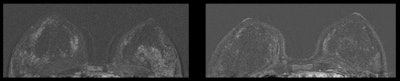 Breast MRI of a 45-year-old patient. The left image is with an IUD in place, while the right image is from the same patient 32 months after IUD removal.