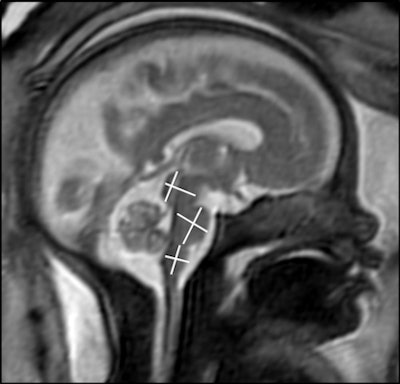 A research team led by Dr. Sophia Stöcklein from the Ludwig Maximilian University of Munich in Germany used MRI to show that fetal brains had age-appropriate developments even as their expectant mothers presented with mild to moderate COVID-19 symptoms. Image courtesy of the RSNA.