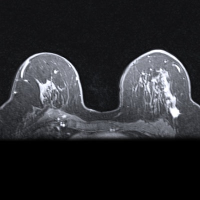 2019 07 16 19 23 2822 Mri Breast 400