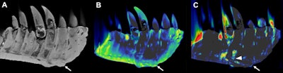 CT reconstructions of the tooth-bearing part of the left dentary. (A) Reconstruction of the conventional CT images in lateral view showing well-preserved anatomical structures, such as the replacement teeth. The arrow indicates the focal exophytic mass -- the abnormal growth that sticks out from the surface of the tissue -- on the ventral surface at the level of the third to fifth tooth roots. (B) The DECT-based calcium material map shows a homogeneous mineral distribution, while (C) the fluorine material map shows significant mineral accumulation in the center of the exophytic mass and adjacent tooth roots (arrowhead). All images courtesy of Hamm et al.