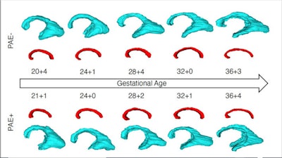 MRI super-resolution reconstruction and atlas-based tissue segmentation. (A, B) Postprocessed MRI super-resolution reconstructions in axial and sagittal planes of a fetus at 26+6 GW. (C, D) Respective manually corrected atlas-based tissue segmentation. Color coding: Blue, external cerebrospinal fluid spaces; red, cortex; orange, subcortical parenchyma; brown, periventricular zone; dark green, ganglionic eminence; white, ventricular system; dark blue, corpus callosum; yellow, deep gray nuclei (basal ganglia and thalamus); light green, brainstem; light blue, cerebellum; turquoise, left hippocampus; gray, right hippocampus. Image and caption courtesy of the RSNA.