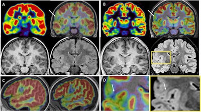 Comparison between PET+MRI (A) and PET/MRI (B); axial and coronal plane, PET alone and co-registered on MRI. The subject is a 17-year-old female with drug-resistant epilepsy since the age of 2 years; nocturnal frontal seizures (3 times per night), left frontotemporal ictal onset, negative MRI (3 tesla). Her first PET examination co-registered on MRI at 11 years considered negative; PET/MRI six years later, showing a focal hypometabolism involving the posterior part of the left orbitofrontal cortex, relative involvement of the adjacent cortex (gyrus rectus, anterior part of the left inferior frontal gyrus) and the temporal pole. This hypometabolism was retrospectively found on the previous PET but remained inconclusive. Note that the co-registration was imperfect on this examination, whereas it was almost perfect on the PET/MRI, allowing a better confidence for the visual analysis. The patient was operated on without invasive monitoring despite a negative MRI scan. Surgery was based on a PET/MR guided cortical resection, including the hypometabolic orbitofrontal cortex and the adjacent inferior frontal gyrus, in front of Broca area. FCD type 2 A was found in the cortical specimen. The patient has been seizure-free for two years and the use of antiepileptic drugs greatly reduced. Image courtesy of Epilepsy Research.