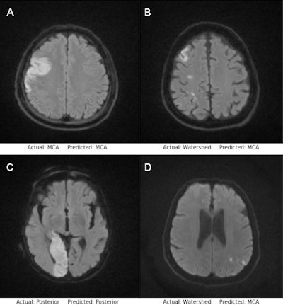 Examples of successful classification (A, C) and misclassification (B, D) by the MobileNetV2 model (top row) and EfficientNetB0 model (bottom row). Image courtesy of the European Journal of Radiology.