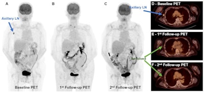 Complete metabolic response to therapy. A 72-year-old male with metastatic melanoma. Maximum intensity projection (MIP) of baseline (A) and transaxial fused (D) F-18 FDG-PET/CT images show a hypermetabolic right axillary lymph node (blue arrow), which is resolved on both first (B [MIP] and E [fused transaxial]) and second (C [MIP] and F [fused transaxial]) follow-up studies (green arrows). Image courtesy of the European Journal of Radiology.