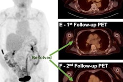 2021 12 16 00 38 6234 2021 12 15 Fdg Uptake Melanoma 20211216000259
