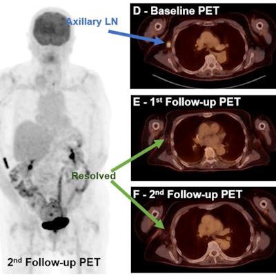 2021 12 16 00 38 6234 2021 12 15 Fdg Uptake Melanoma 20211216000259