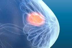 2020 05 27 21 35 5485 Breast Cancer3 400