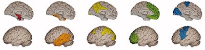 Surface-based rendering of event-based modeling (EBM) tau PET stages (I through V, left to right). Image courtesy of JAMA Neurology.