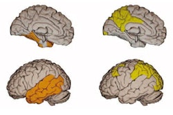 2021 12 23 19 29 0282 2022 01 03 Tau Pet Brain Stages 400