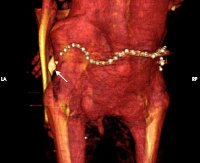 3D CT image of the surface of the lower back of mummy Amenhotep I shows a beaded metallic girdle (likely gold) at the back of the pelvic region and a faience amulet in the shape of a snail shell (arrow) in the left hip region. All images courtesy of Dr. Sahar Saleem et al and Cairo University.