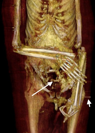 3D frontal CT of the lower torso and upper limbs of the mummy of Amenhotep I. The right forearm is flexed at the elbow and crosses the lower abdomen transversely; the right hand is dislocated at the wrist and is displaced anterior to the forearm. The dislocated left arm and forearm are placed extended along the left side of the body. The broken left (hand) has three flexed fingers; the missing two fingers are seen inside an anterior abdominal wall defect (long arrow). The fractures were probably inflicted by tomb robbers. The initial position of the arms was probably crossed in front of the body. A short pin is placed transversely across the bandages (short arrow) likely to fix the left disarticulated arm in place.