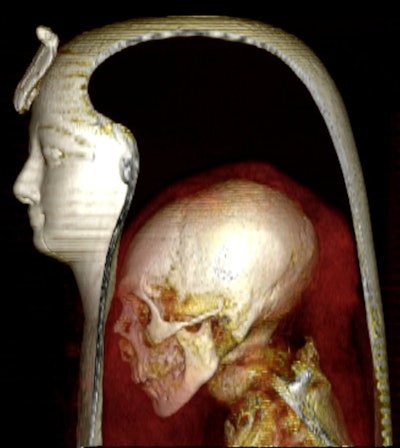3D CT image of the head of the wrapped mummy of Amenhotep I in a left lateral view allows visualization of the component layers: the mask, the head of the mummy, and the surrounding bandages.