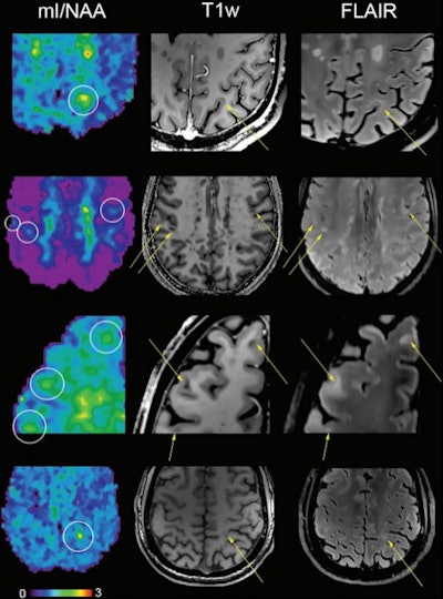 Metabolic maps showing the ratio of myo-inositol to N-acetylaspartate (mI/NAA) clearly depict small subcortical or juxtacortical lesions (circles) that appear inconspicuous at T1-weighted MRI (T1w)/fluid-attenuated inversion-recovery (FLAIR) imaging.