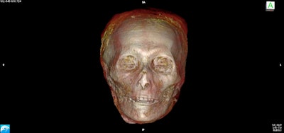 The 3D CT image showed an oval face with a narrow chin.