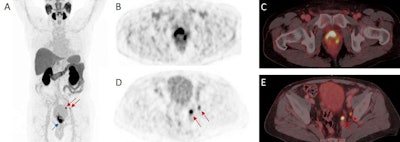 A 72-year-old patient with high-risk prostate cancer (iPSA 44 ng/mL) who underwent F-18 rhPSMA-7.3 PET/CT illustrating the primary tumor (blue arrow) and pelvic lymph node metastases (red arrows) histologically confirmed by radical prostatectomy (pT3b pN1 (2/34), Gleason score 3 + 4 = 7b); (A) maximum intensity projection (MIP), (B, C) PET, (D, E) fused PET/CT images. Figure courtesy of the Journal of Nuclear Medicine.