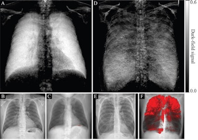 (A, D) Dark-field radiographs, (B, E) attenuation-based radiographs, and (C, F) projections of CT-based emphysema quantification in a healthy 33-year-old man with an emphysema index of 0.1% (A-C) and a 65-year-old man with an emphysema index of 26% (D-F). The same window settings were applied within the respective modality. In B, no abnormalities are apparent. In E, flattened hemidiaphragms and an irregular area of radiolucency are visible. While the dark-field chest radiograph of the healthy subject with no emphysema in the CT-based emphysema projection exhibits a strong homogeneous dark-field signal, the dark-field signal intensity of the subject with pulmonary emphysema appears decreased overall and exhibits an inhomogeneous patchy pattern, corresponding well to the emphysema intensity in the CT-based projection (red overlay, F). Image courtesy of Radiology.