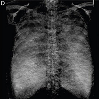 2022 01 13 16 46 5473 2021 01 13 Dark Field Chest X Ray Red Image D 400